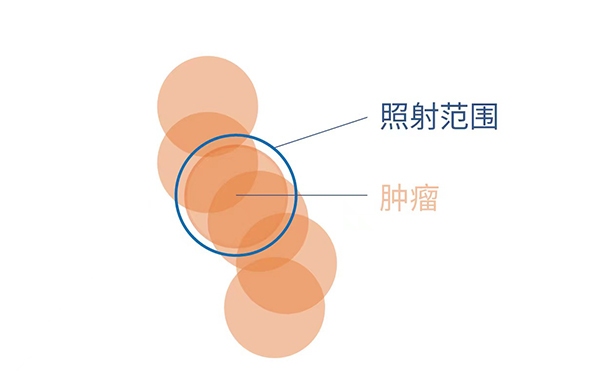 肺癌放疗到底照射哪里？4D扫描观看呼吸周期中肿瘤运动模式