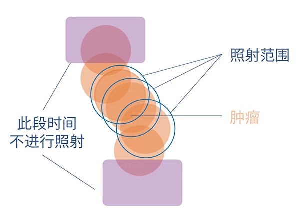 肺癌放疗到底照射哪里？4D扫描观看呼吸周期中肿瘤运动模式