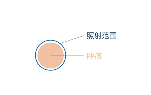 肺癌放疗到底照射哪里？4D扫描观看呼吸周期中肿瘤运动模式