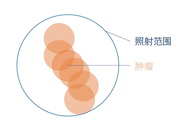 肺癌放疗到底照射哪里？4D扫描观看呼吸周期中肿瘤运动模式